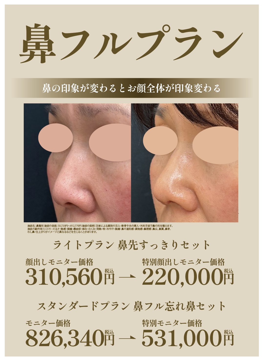 鼻フルプラン