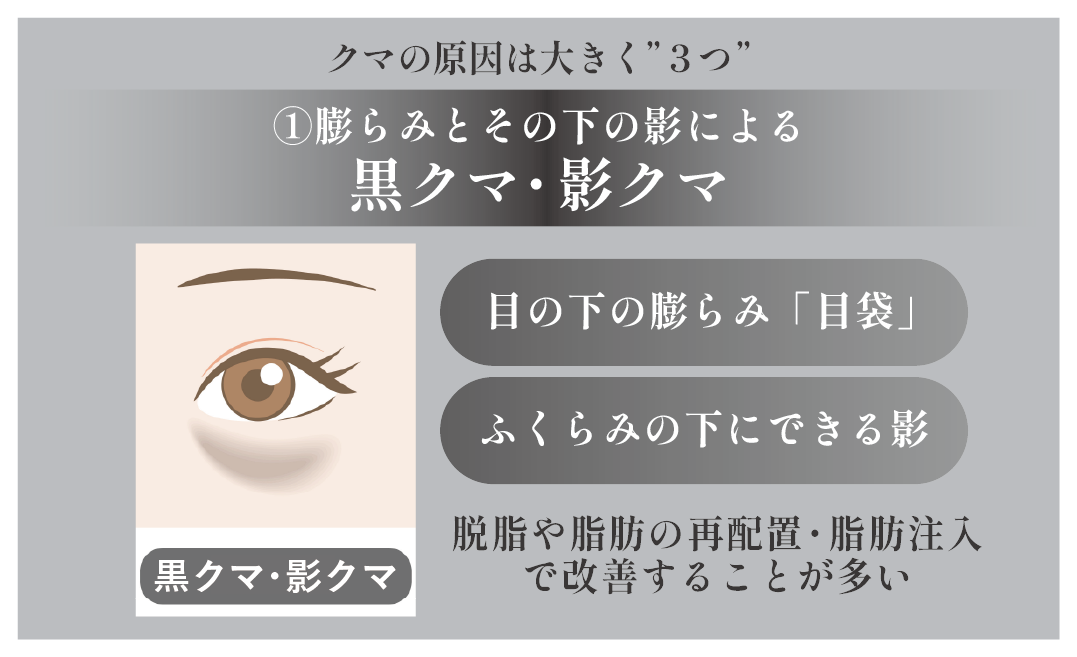 眼窩脂肪の突出による”ふくらみ”とその影による”影・黒クマ”