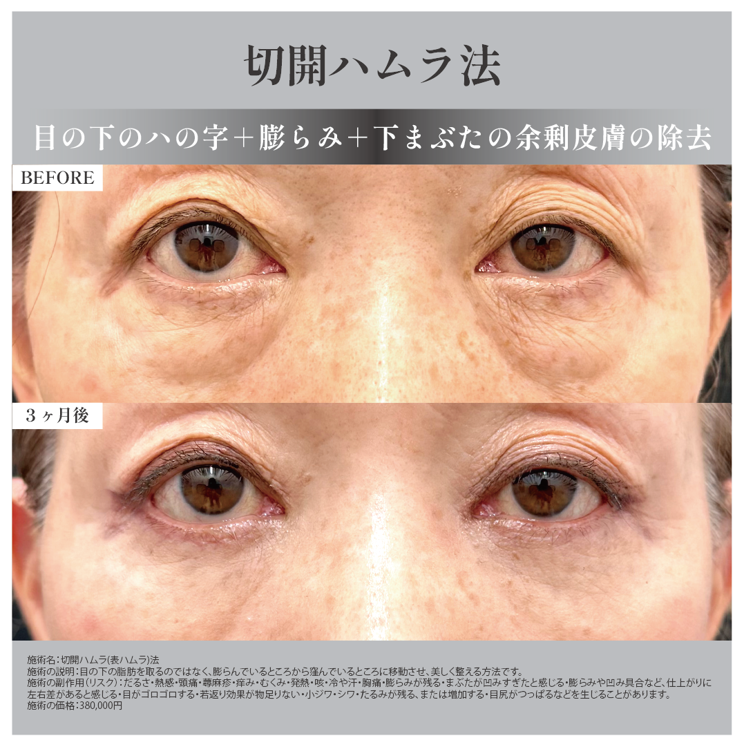 切開ハムラ法