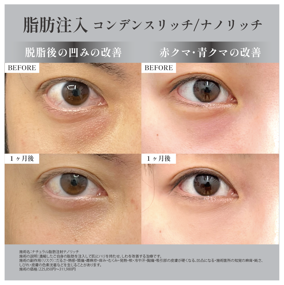 脂肪注入