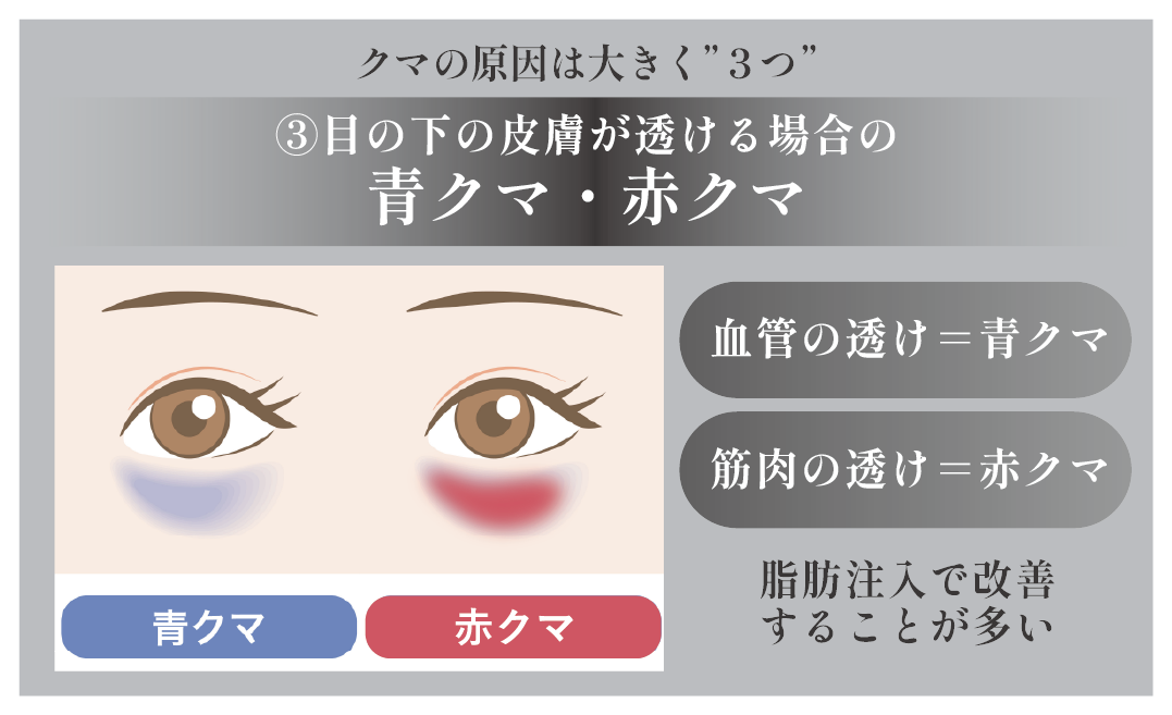目の下の血管や筋肉が透けて見える”赤・青クマ”