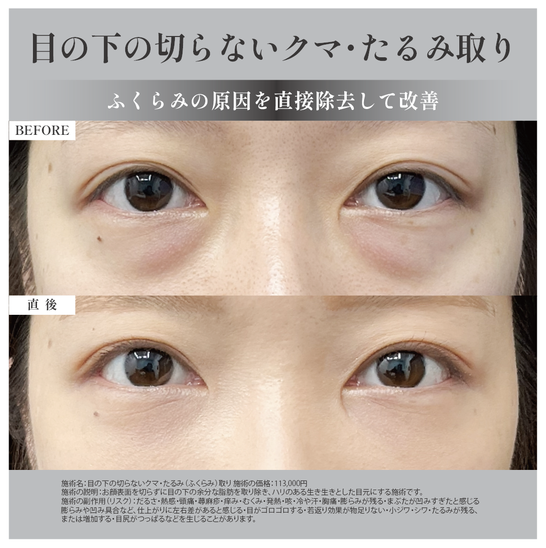 目の下の切らないクマ・たるみ（ふくらみ）取り