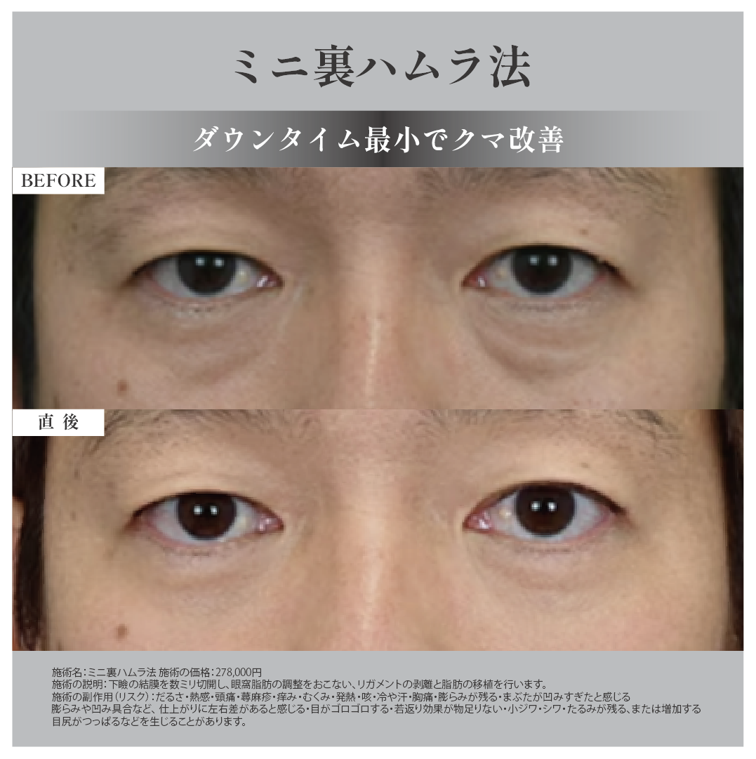 ミニ裏ハムラ