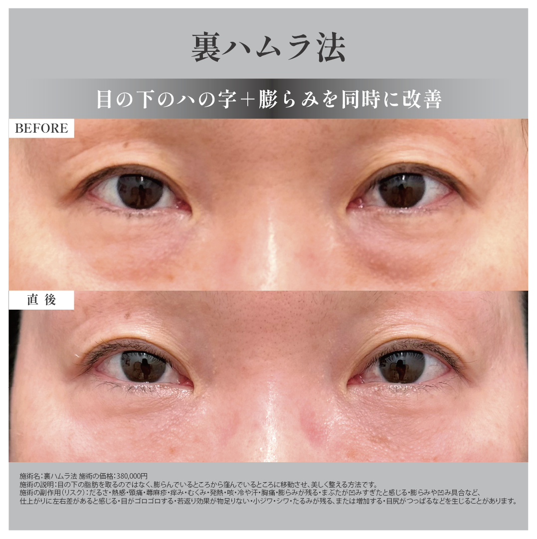 裏ハムラ法