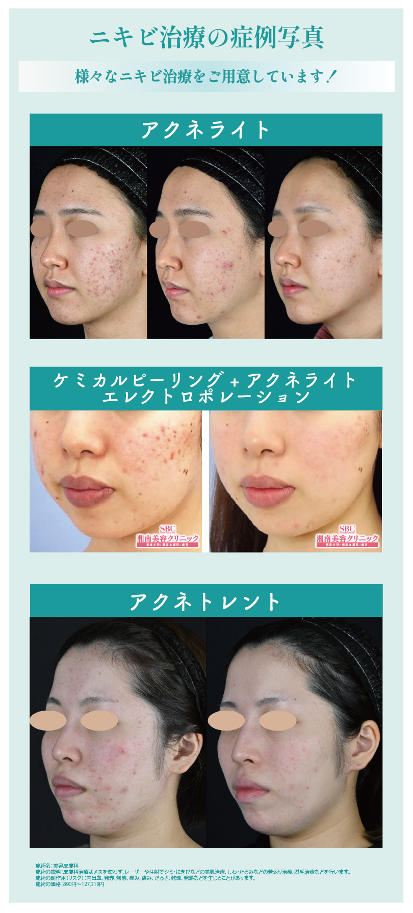 湘南美容クリニックのニキビ治療