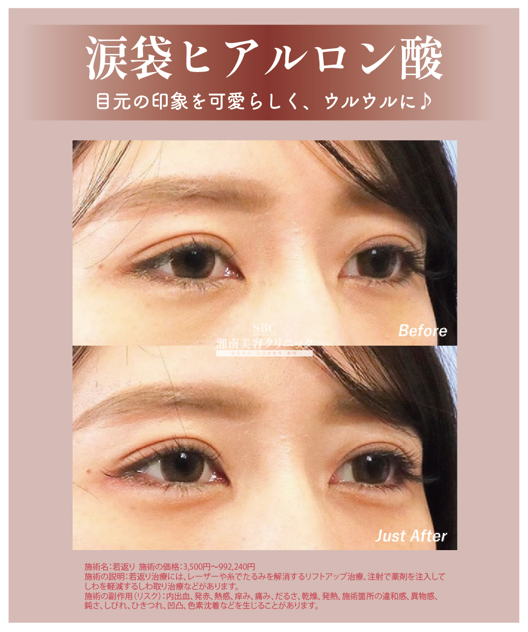 涙袋ヒアルロン酸