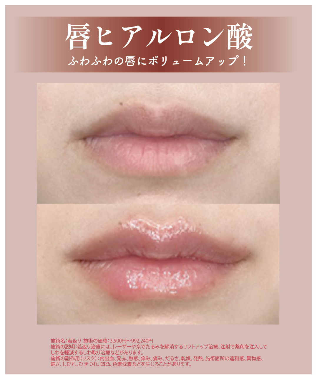 唇ヒアルロン酸