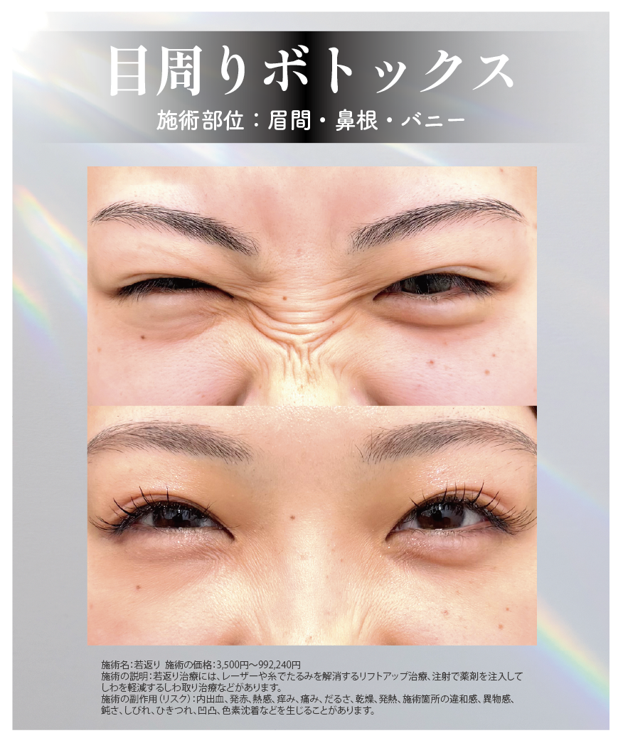 眉間+鼻根+バニーの目周りセット