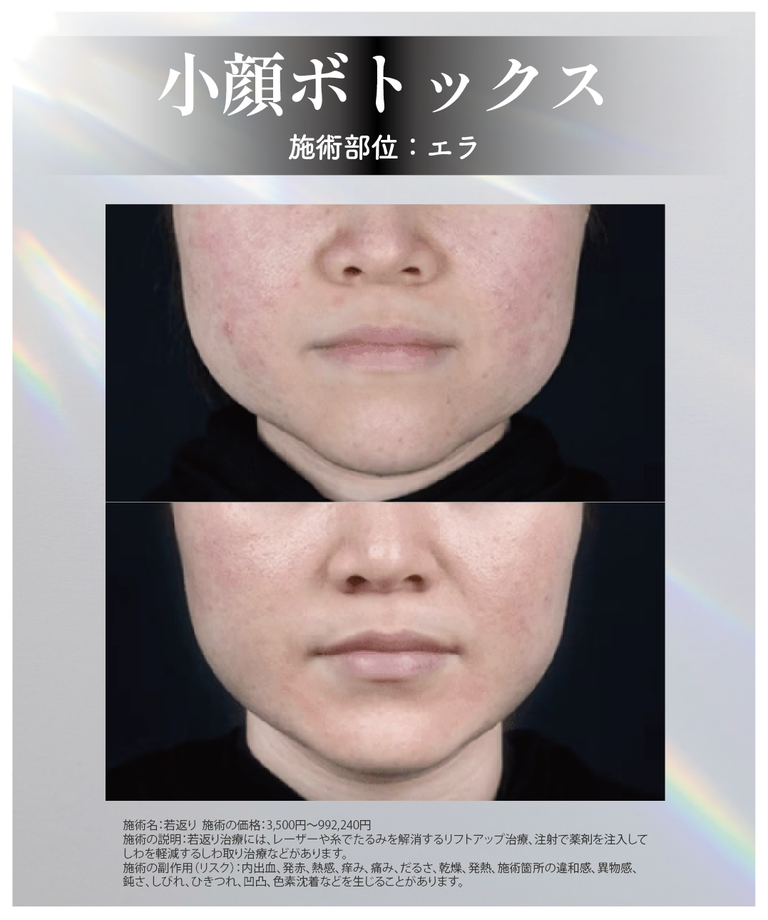 エラ張り・食い縛りの改善にエラボトックス
