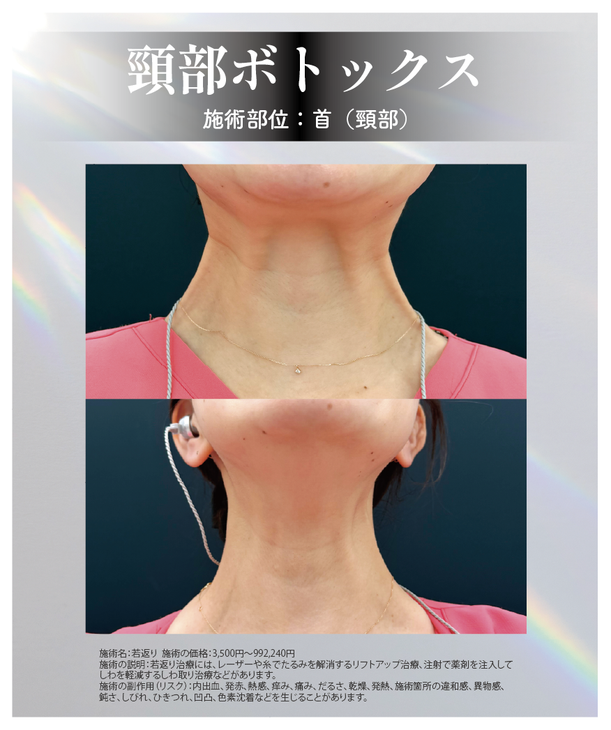 フェイスラインを整える頸部ボトックス
