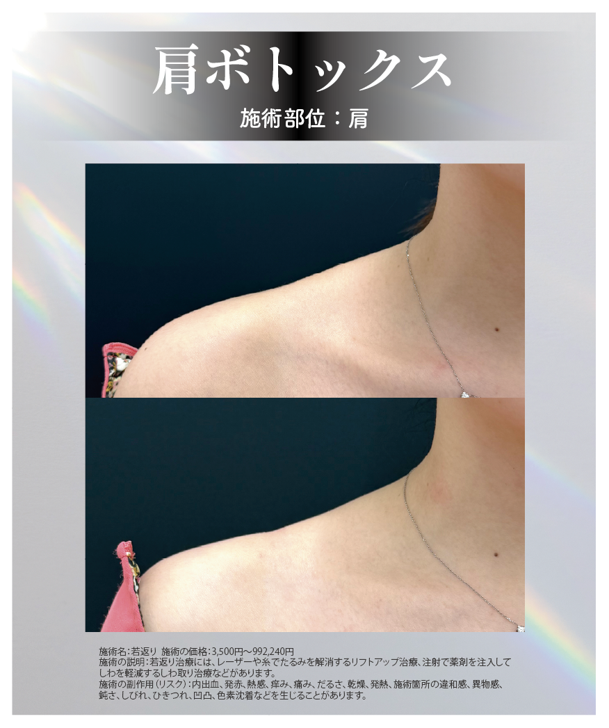 肩を華奢に見せる+肩こり改善の肩ボトックス