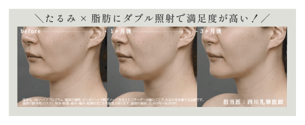 ダブル照射で満足度の高い効果を！