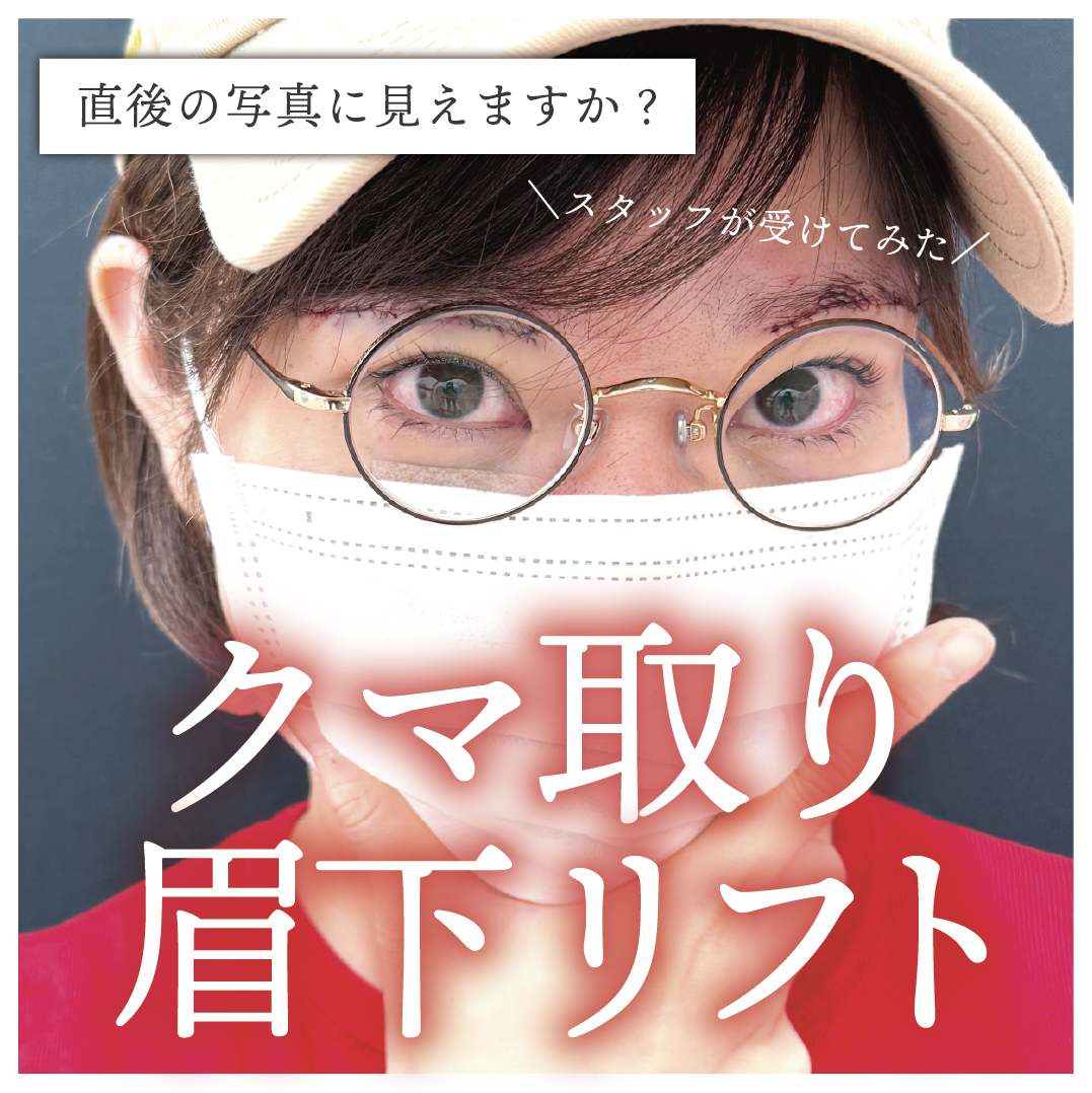【 スタッフが受けてみた ！】目のクマ+まぶたのたるみ改善治療「裏ハムラ」「眉下リフト」レポート٩( ᐛ )و