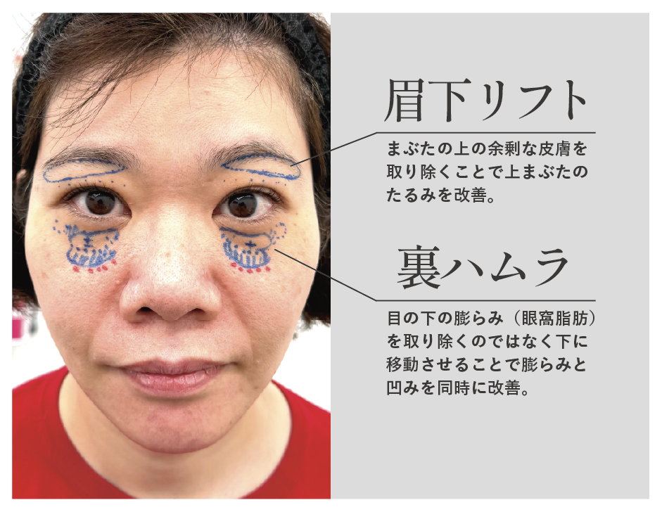 ✴︎隠れクマとまぶたのたるみはこうする。