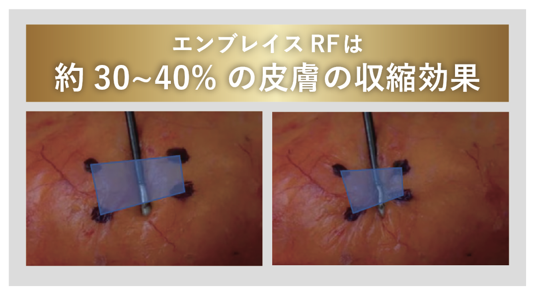 エンブレイスRF＝強力な引き締め効果！