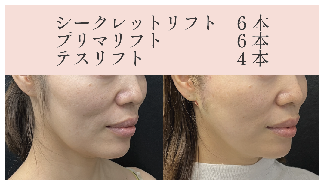 頬の下がり・フェイスラインがスッキリ！