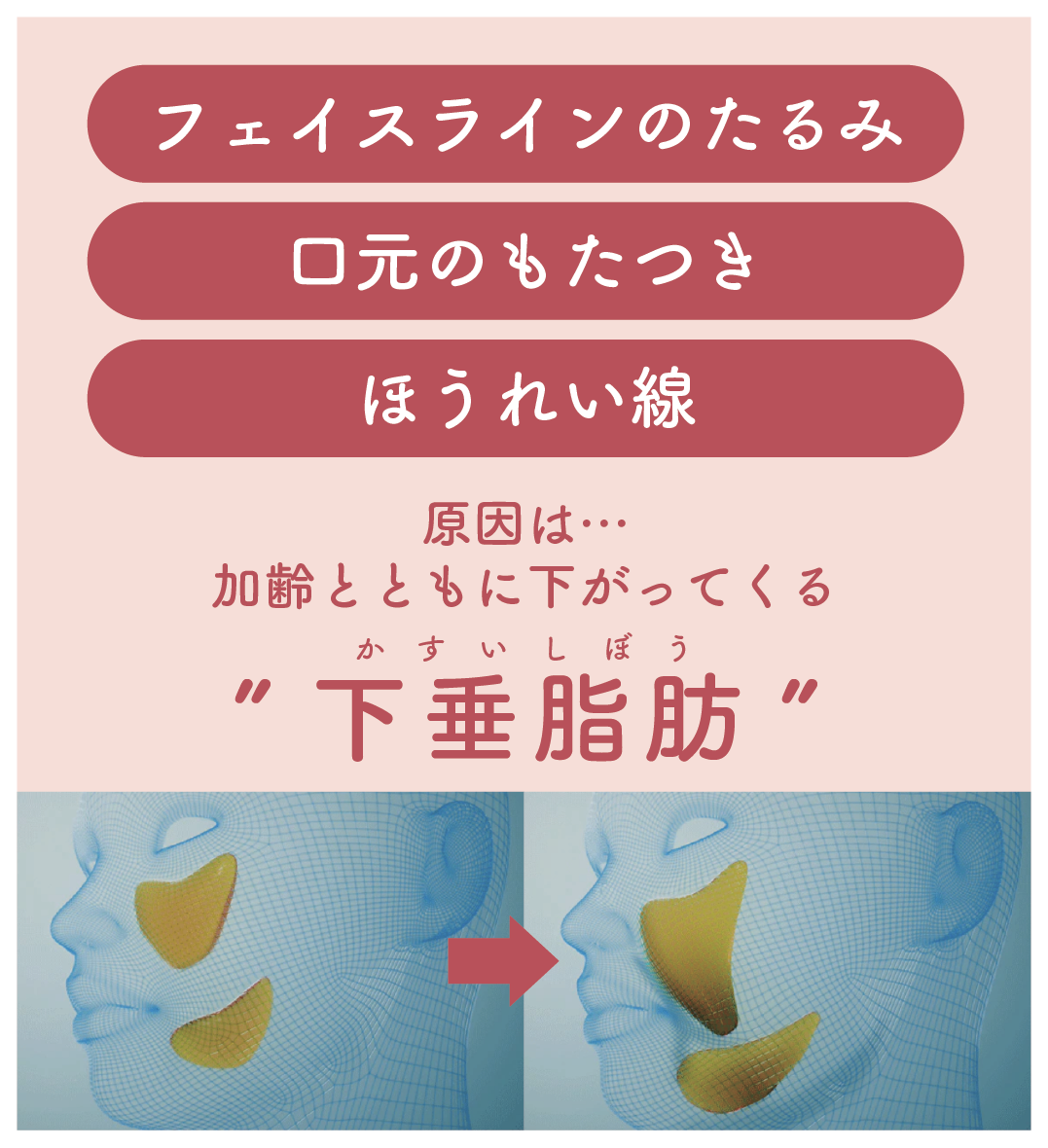お顔のたるみ＝下垂脂肪が原因☝️