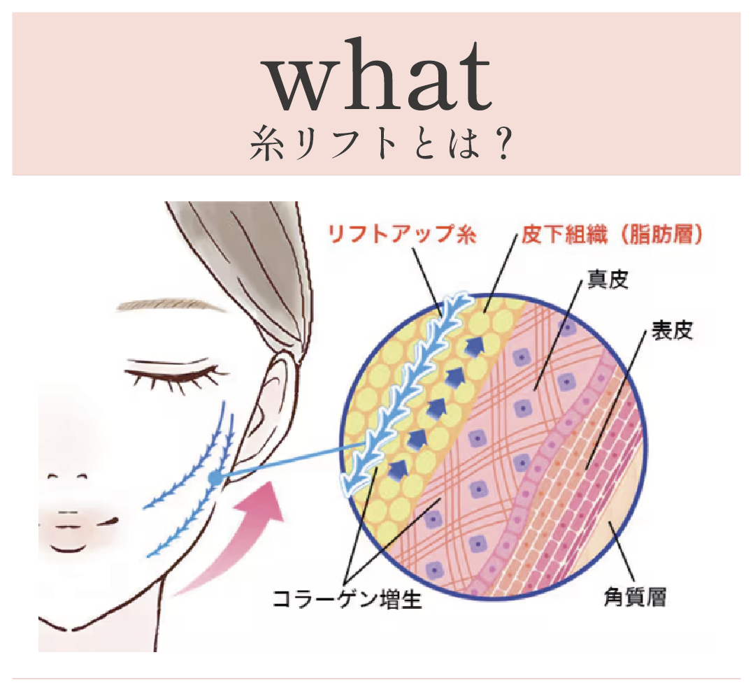 糸リフトの仕組み