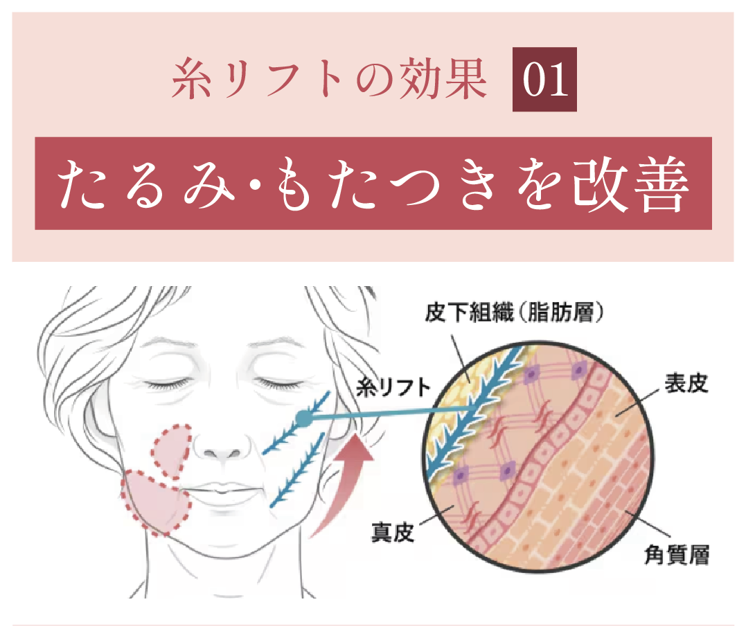 効果① たるみ・もたつきの改善