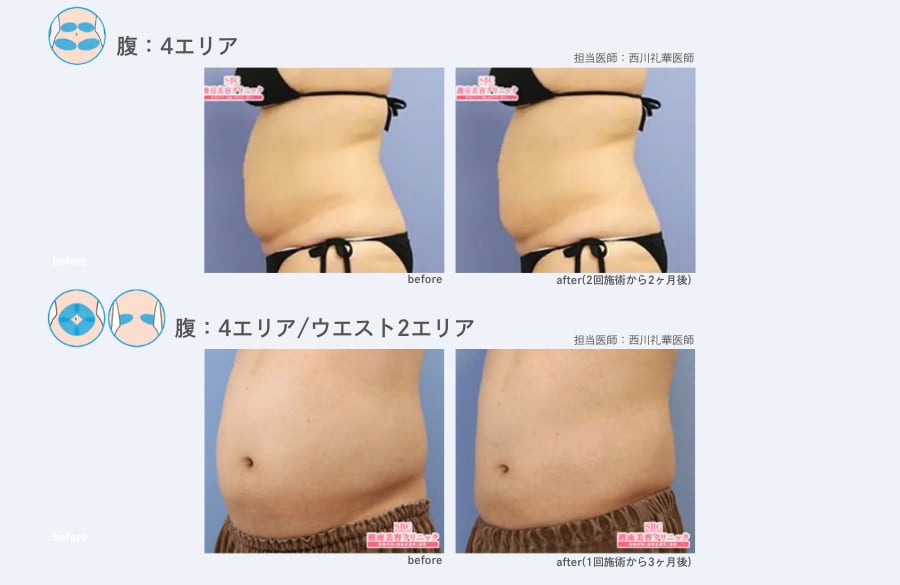 【腹】クールスカルプティング 症例写真