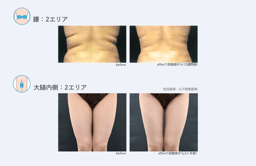 【背中】【太もも】クールスカルプティング 症例写真