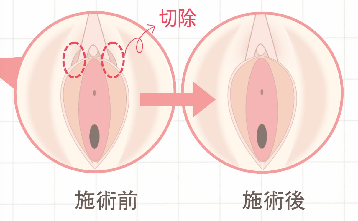 🔹 副皮除去