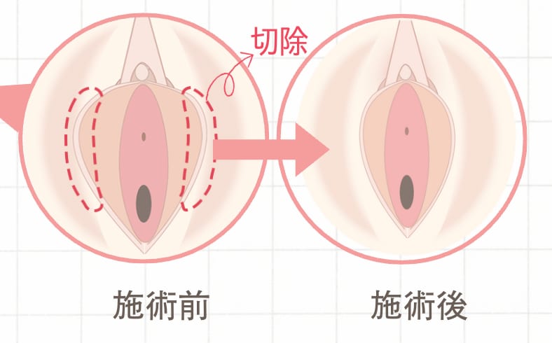🔹 小陰唇縮小術