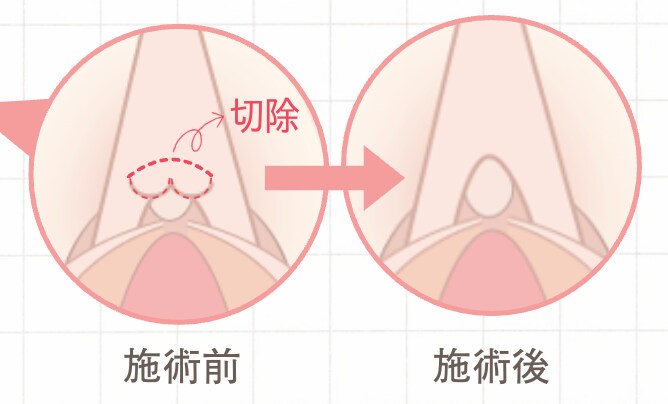 🔹 クリトリス包茎手術