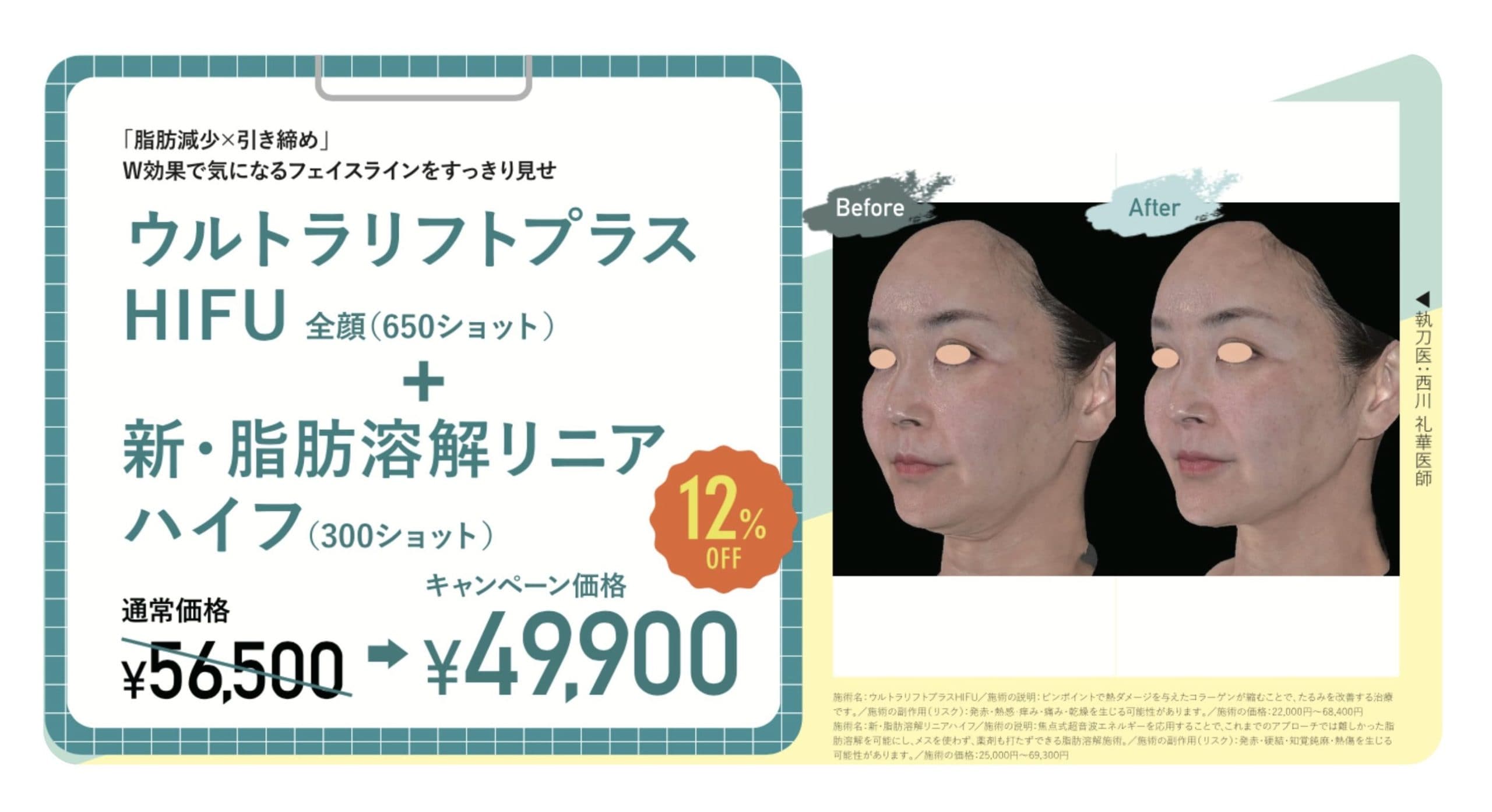 ウルトラリフトプラスHIFU