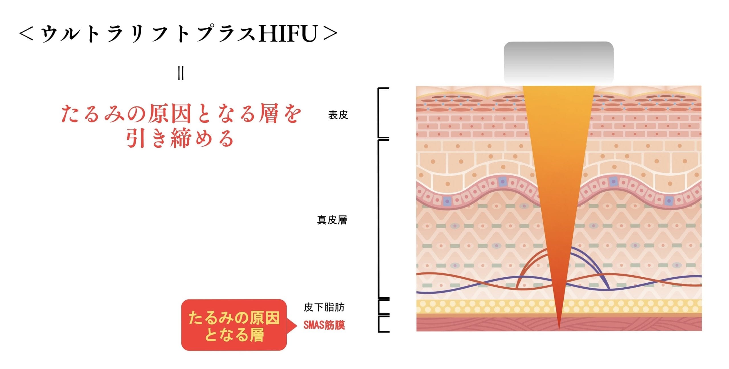 たるみを強力に引き上げる「ウルトラリフトプラスHIFU」