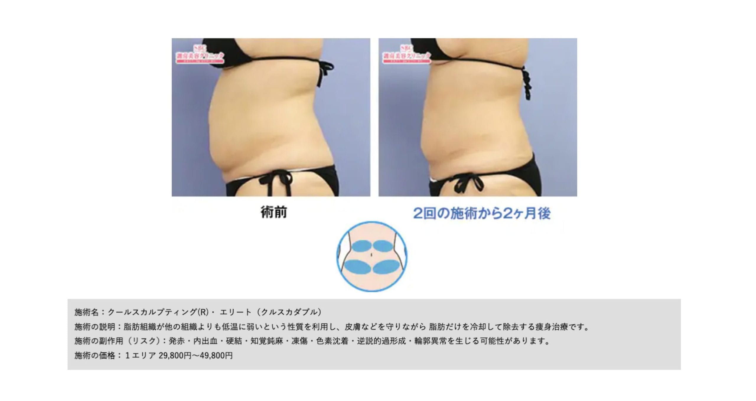 脂肪を冷却&破壊!!🧊<br />
落ちにくいお腹や二の腕の部分痩せをしたい方におすすめ‼️<br />
