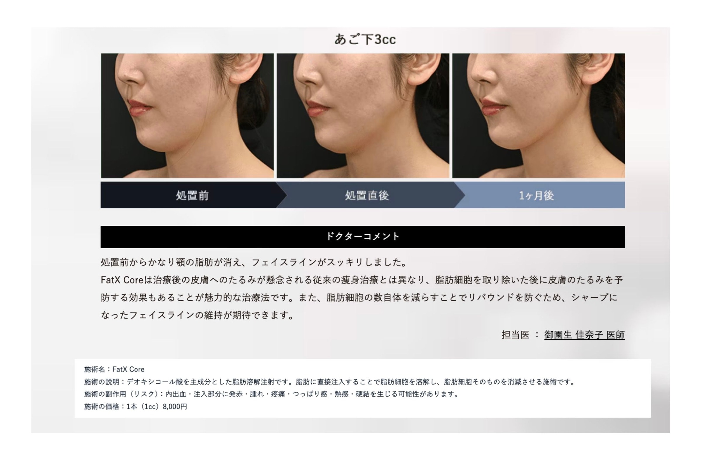 顔やあご下の脂肪を狙い撃ち！新世代の脂肪溶解注射💉