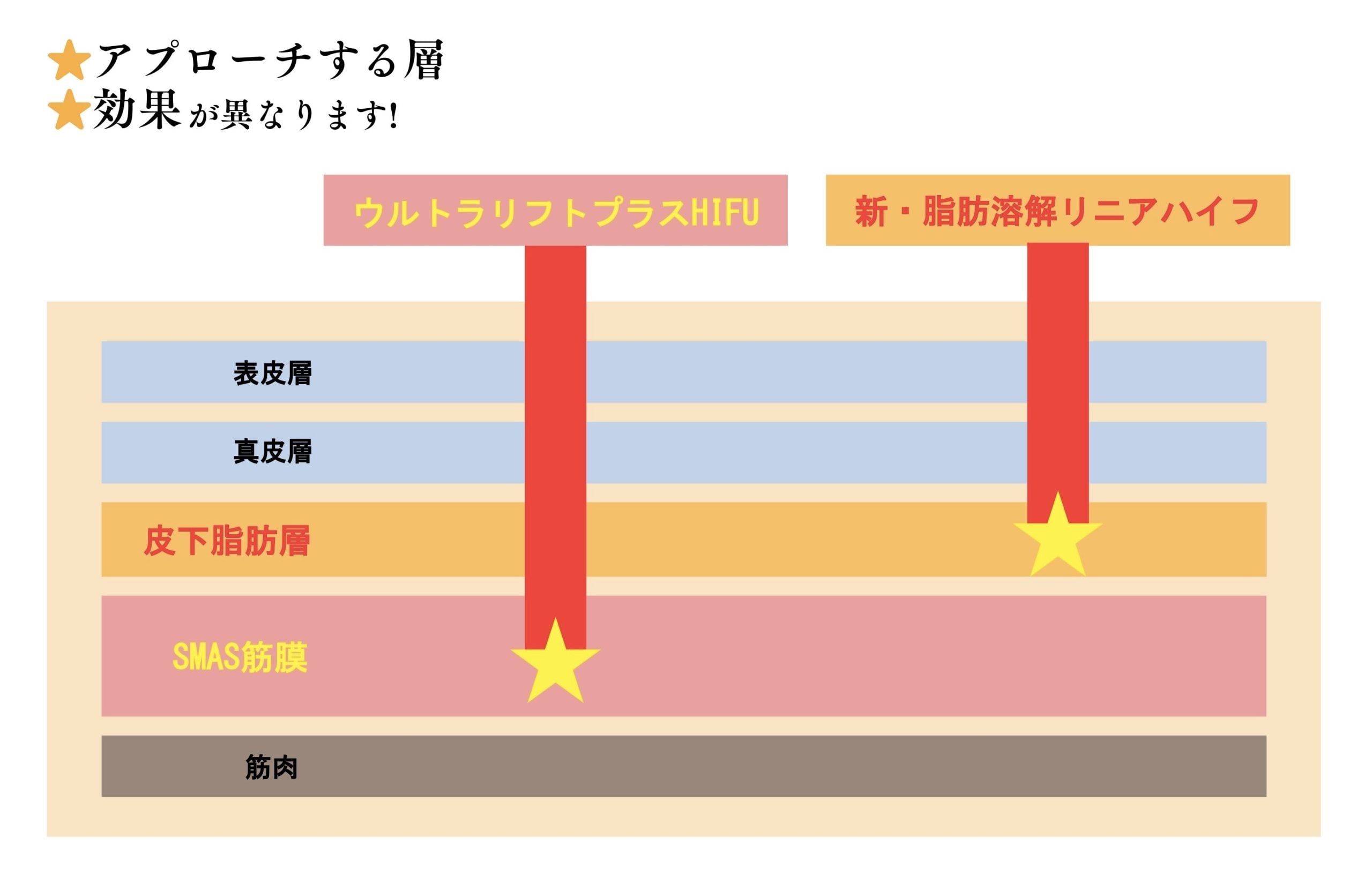 「ウルトラリフトプラスHIFU」と「新・脂肪溶解リニアハイフ」の違いって?