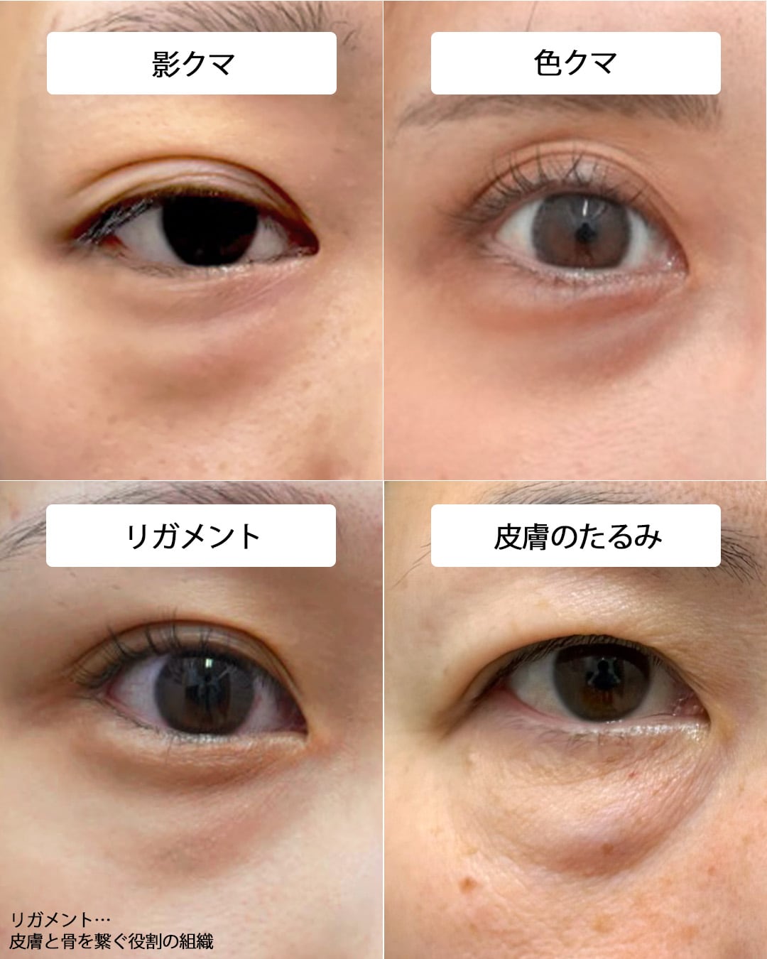 【悩み別】クマの種類