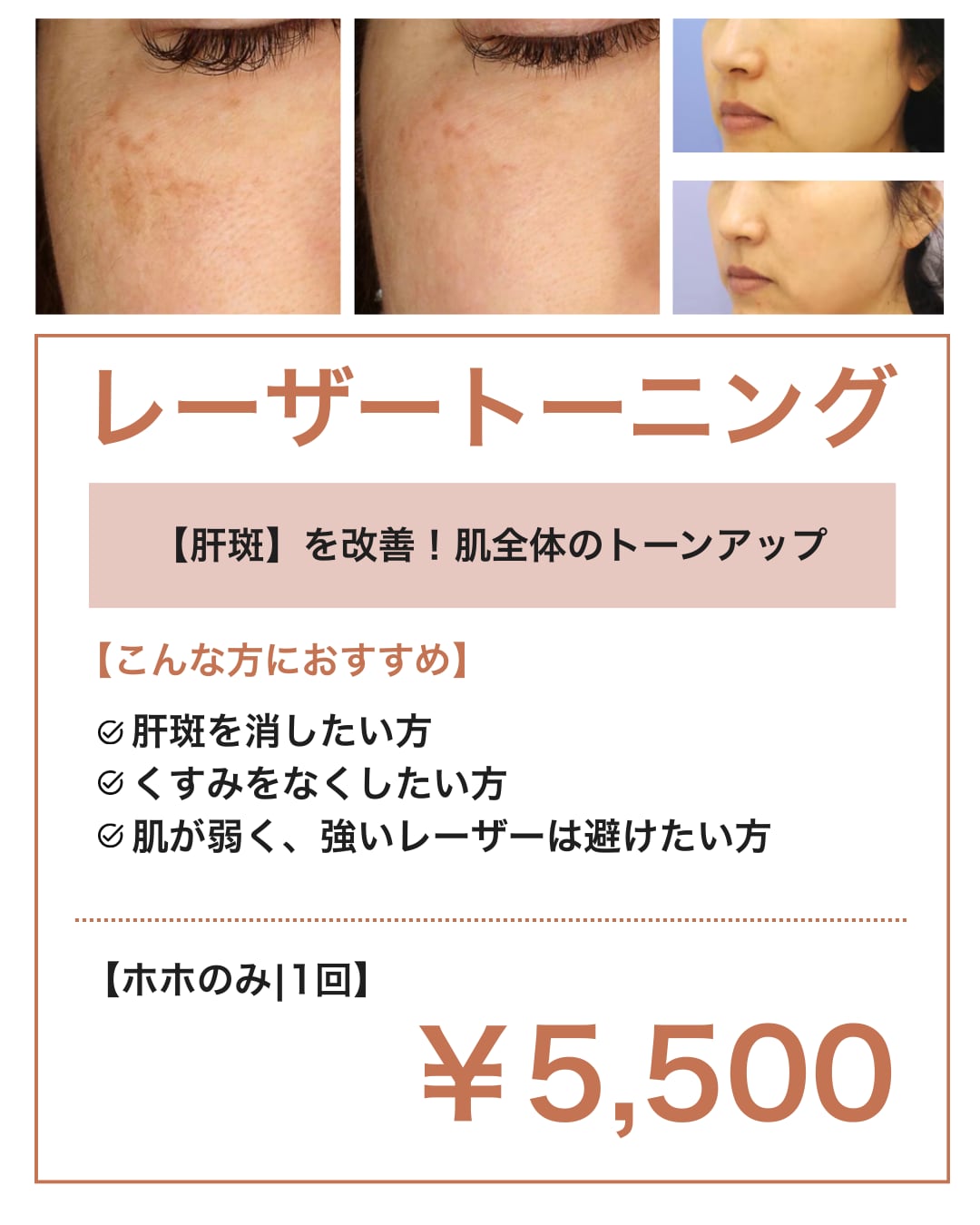 レーザートーニング