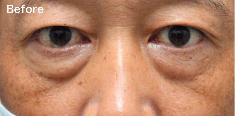 目の下の”ふくらみ”が気になる方!