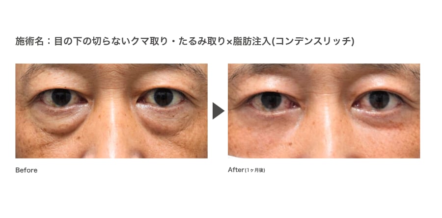 ②脱脂×脂肪注入（コンデンスリッチ）
