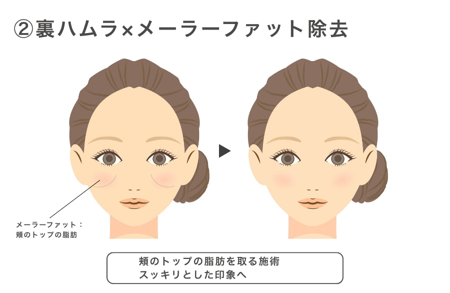 ②裏ハムラ×メーラファット除去