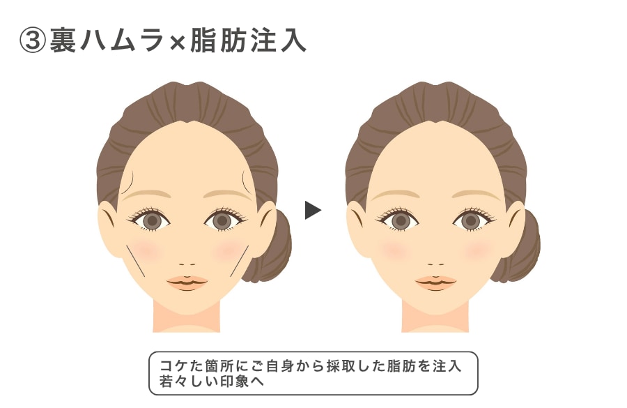 ③裏ハムラ × 脂肪注入（コンデンスリッチ等）