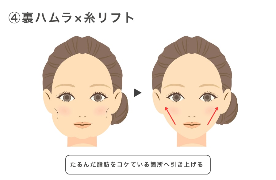 ④裏ハムラ×糸リフト