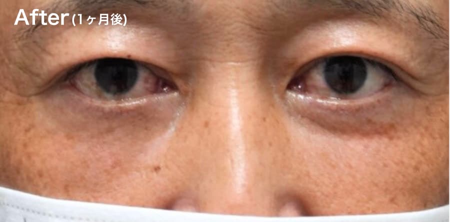 目の下の”ふくらみ”が気になる方!