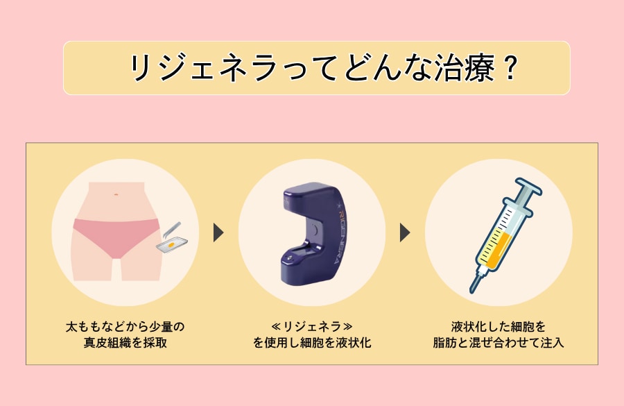 リジェネラの仕組み