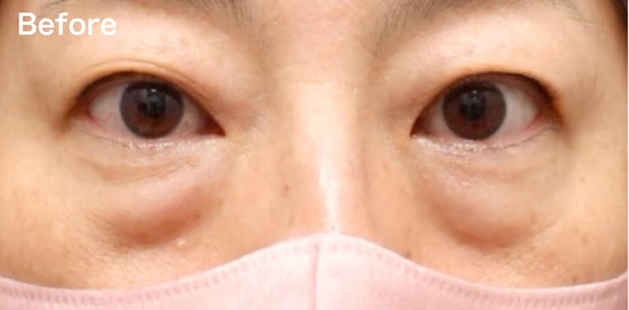 ”凹み”・”目の下のライン”が気になる方!