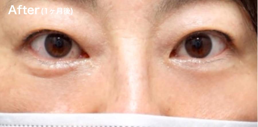 ”凹み”・”目の下のライン”が気になる方!