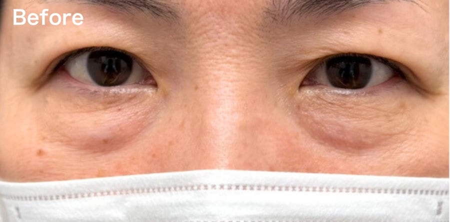 目の下の”たるみ”が気になる方!