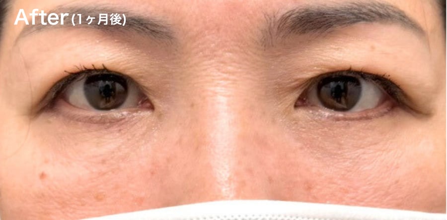 目の下の”たるみ”が気になる方!