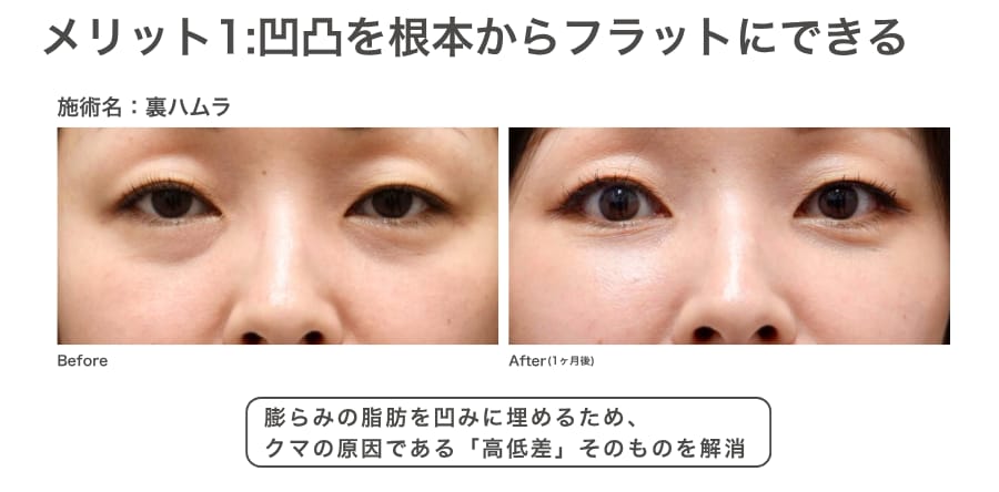 メリット1：クマの原因である『凹凸』を根本から解消