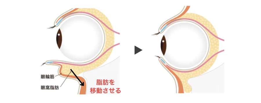 「裏ハムラ法」とは？