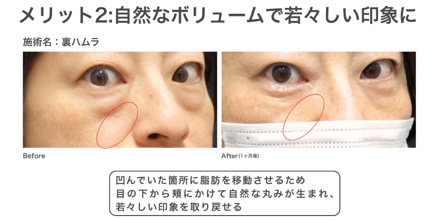 メリット2：自分の脂肪で『自然なボリューム』を再配置