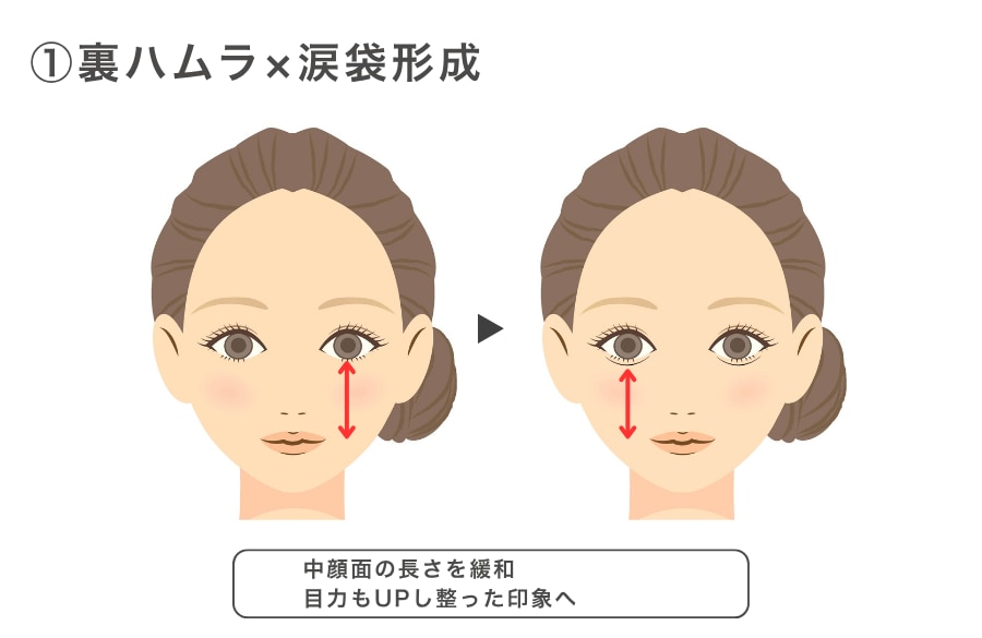 ①裏ハムラ×涙袋形成（ヒアルロン酸等）
